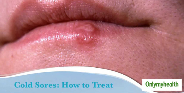 Treatment for cold sores in mouth deals